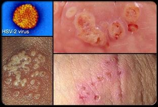 Illustration for article titled Obat Penyakit Herpes